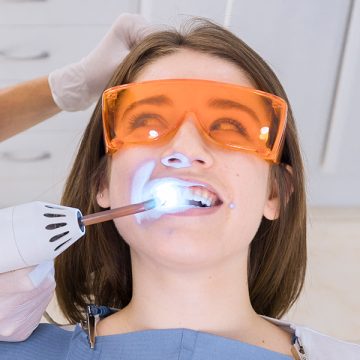Dental Bonding: What is Teeth Bonding & What to Expect